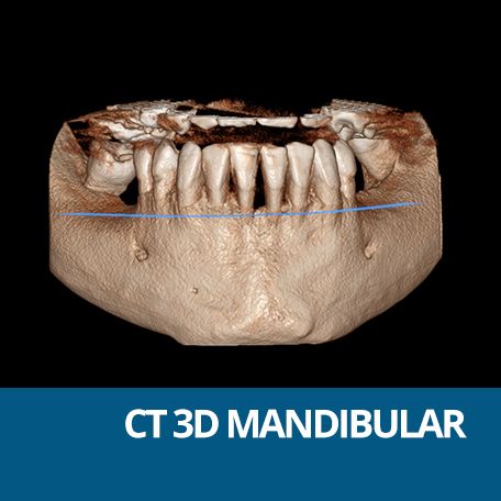 CT MANDIBULAR