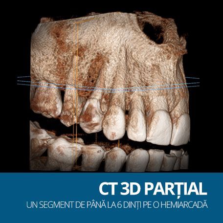 CT PARTIAL